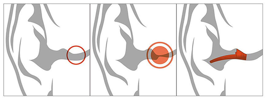 A growing number of EXOSTOSIS PATHOLOGIES